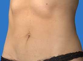 Abdomen Front After VASER Lipo